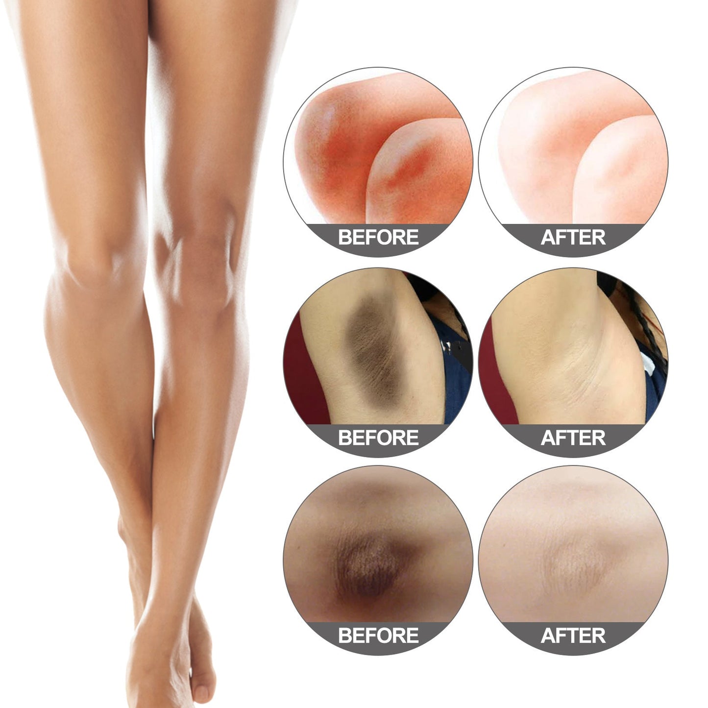 Dim Elbow Knee Dark Peel Brightening Skin Care
